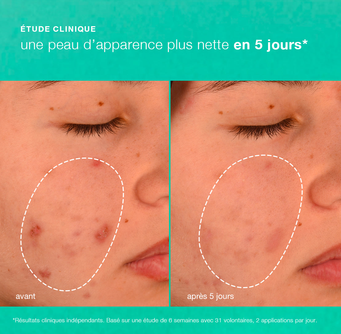 breakout biotic moisturizer | hydratant prébiotique anti-imperfections