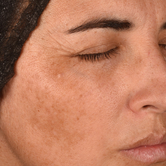 Pores dilatés : comprendre les causes et améliorer visiblement le grain de peau