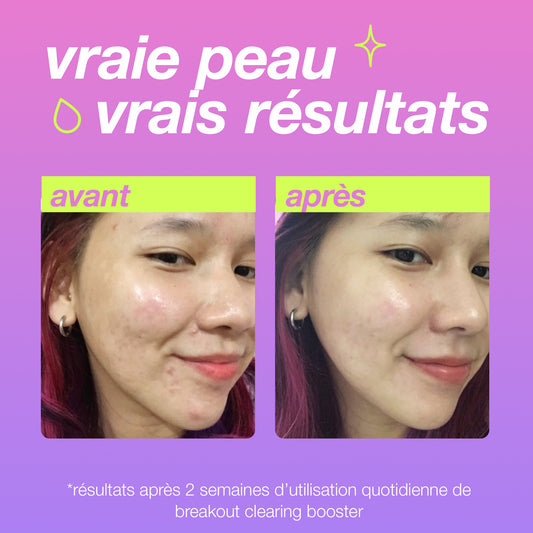 breakout clearing booster | booster anti-imperfections à l'acide salicylique - peaux jeunes