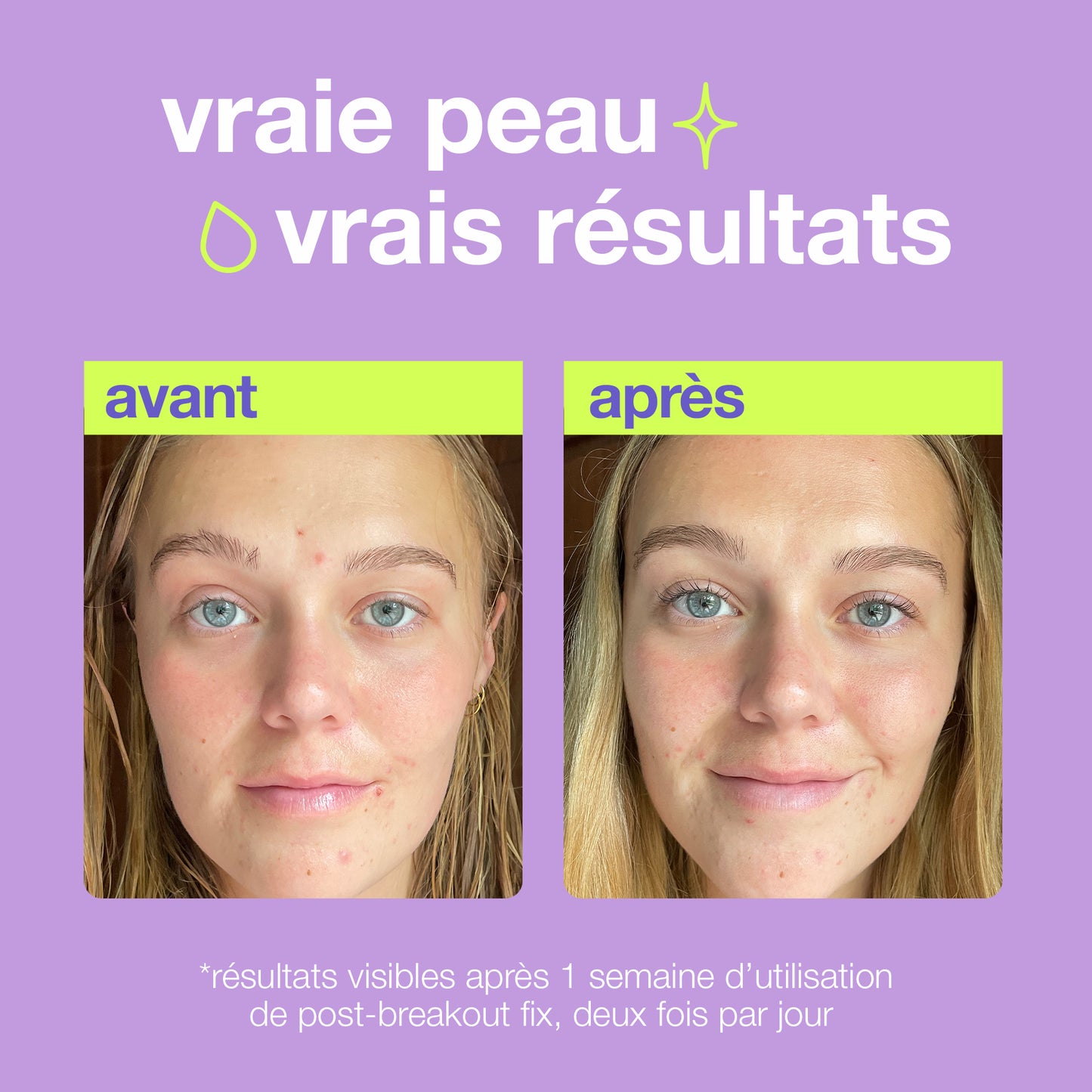 post-breakout fix | solution post-éruption cutané