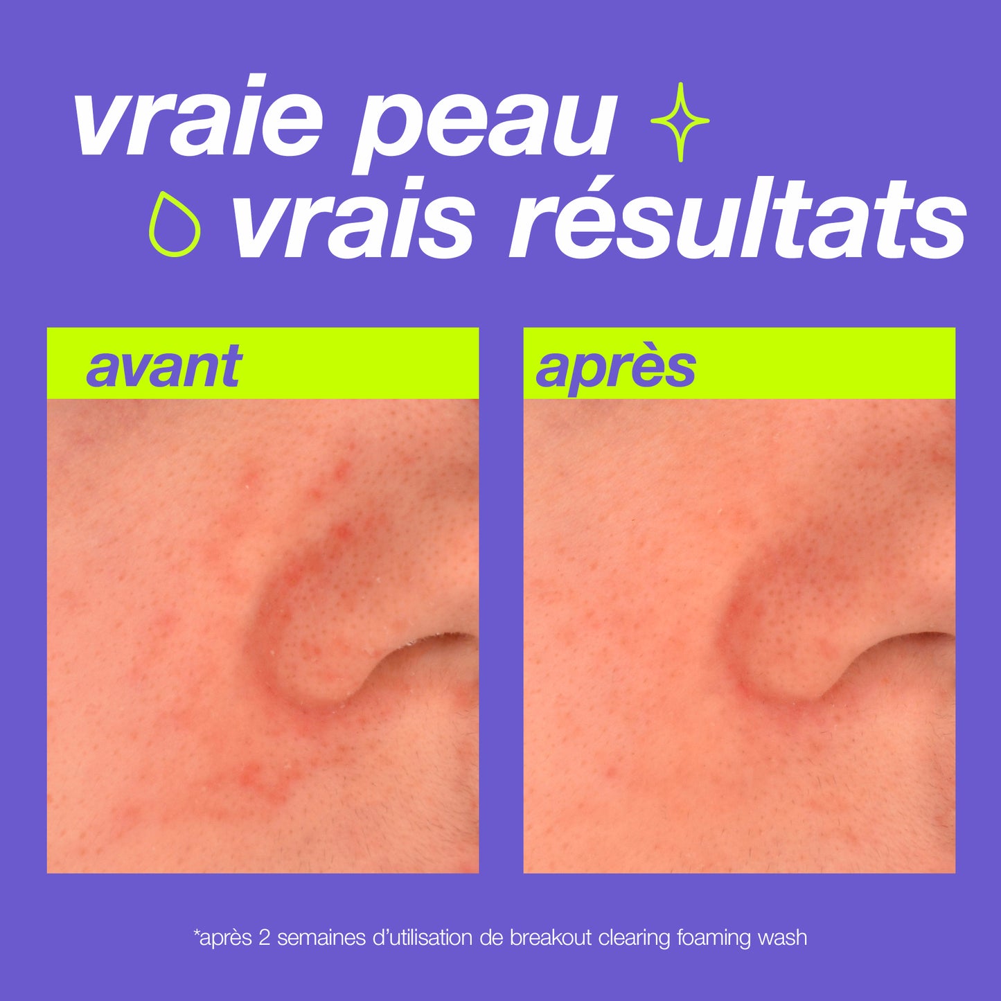 breakout clearing foaming wash | gel nettoyant anti-imperfections peaux jeunes