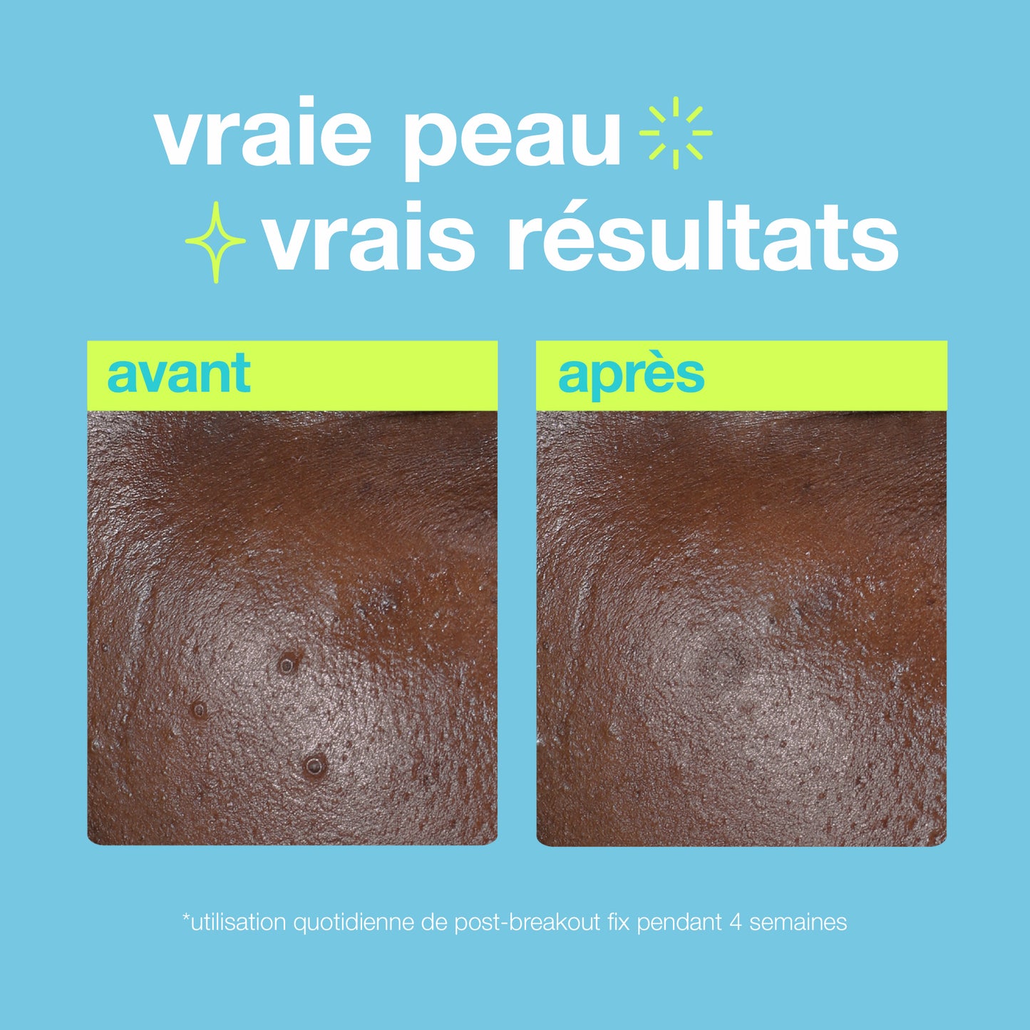 post-breakout fix | solution post-éruption cutané