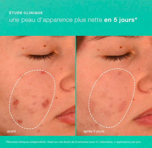 breakout biotic moisturizer | hydratant prébiotique anti-imperfections