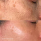 Melanopro peel system  | traitement de l'hyperpigmentation