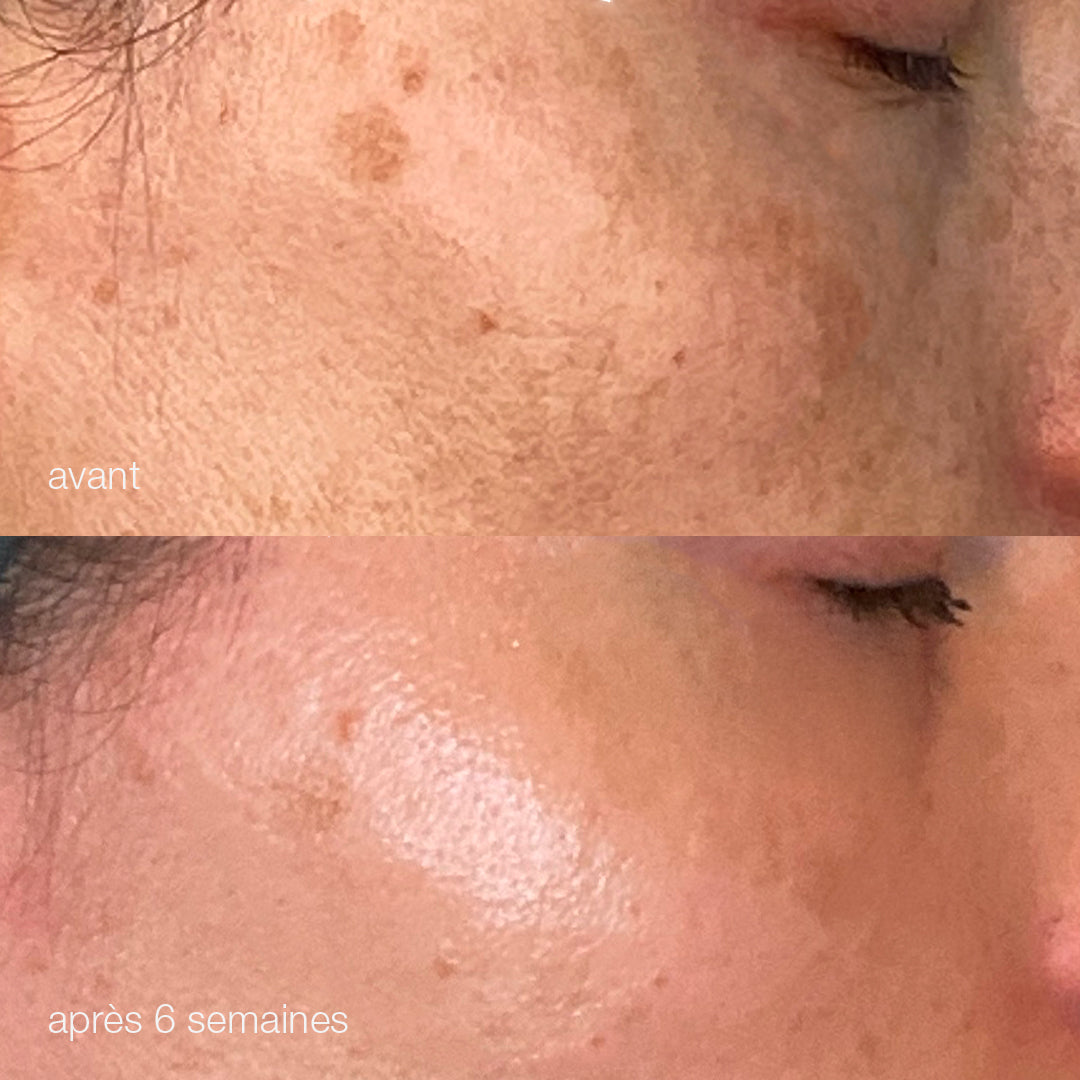 Melanopro peel system  | traitement de l'hyperpigmentation