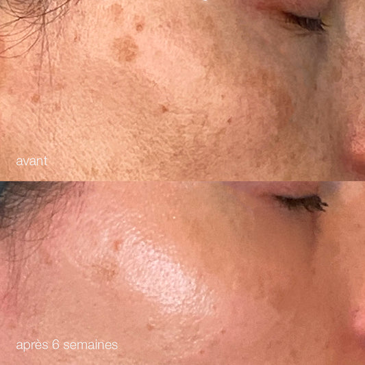 Melanopro peel system  | traitement de l'hyperpigmentation