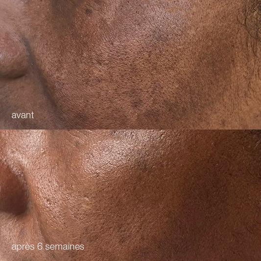Melanopro peel system  | traitement de l'hyperpigmentation