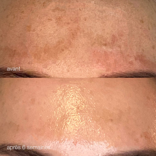 Melanopro peel system  | traitement de l'hyperpigmentation